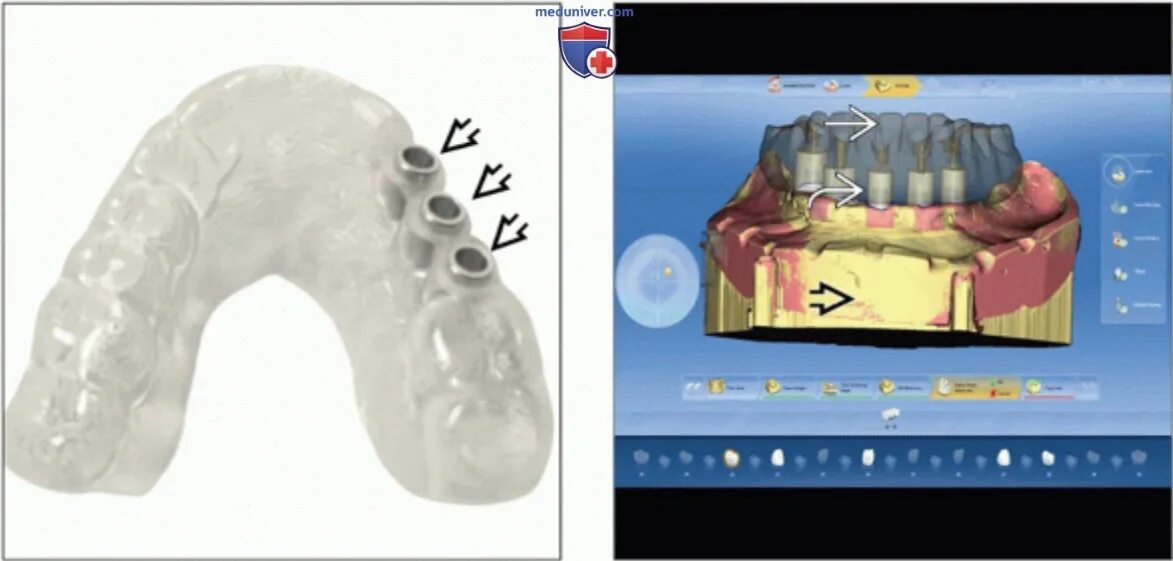 Ври кам. CAD/cam в стоматологии. КАД Кам система в стоматологии состав. Применение УЗТ В стоматологии. Supperiostal CADCAM Implants.