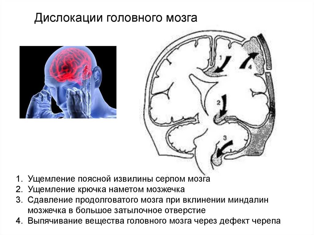 Вклинение ствола головного мозга кт. Симптомы смещения головного мозга. Дислокация срединных структур головного мозга. Аксиальная дислокация головного мозга.