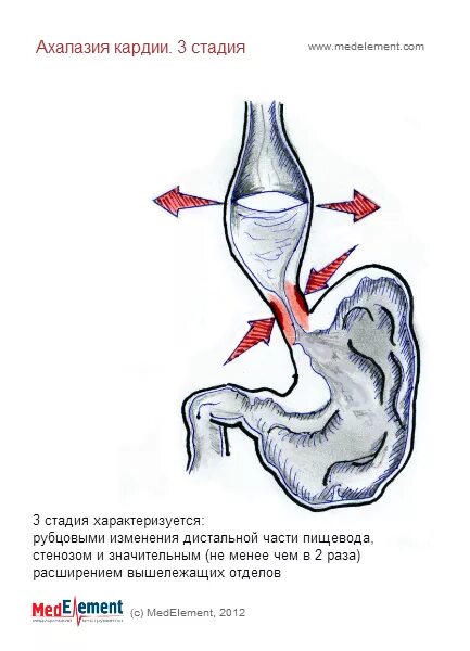 Сужение ахалазия пищевода. Ахалазия кардии пищевода этиология. Ахалазия пищевода 1 степени. Ахалазия пищевода 4 степени. Недостаток кардии