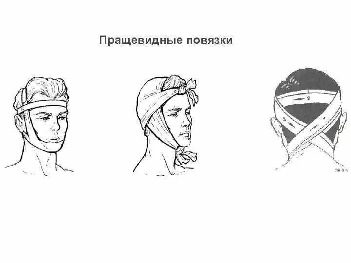 Техника наложения пращевидной повязки