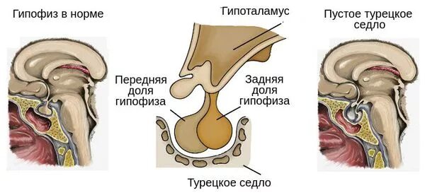 Образование турецкого седла. Гипофиз в турецком седле. Гипофиза синдром пустого турецкого седла. Гипоталамус турецкое седло. Пустое турецкое седло гормоны.