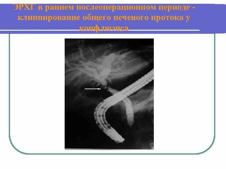 Симптомы забитых желчных протоков. Классификация повреждений желчных протоков. Разрыв желчного протока. Ранние повреждения желчных протоков. Повреждения внутрипечоночной проток.