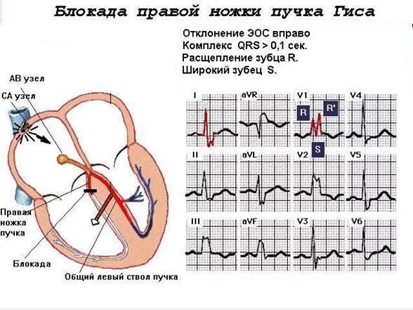 Блокада правого желудочка. Комплекс QRS В v1. Расщепление зубца r в v2. ЭКГ зубец т v 1. Отрицательный зубец р после QRS комплекса.