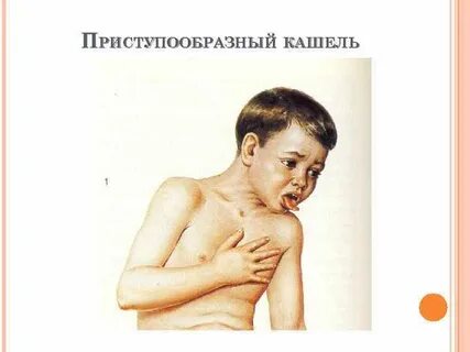 Кашель сухой приступообразный с мокротой