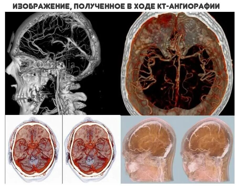 Сосуды головного мозга норма