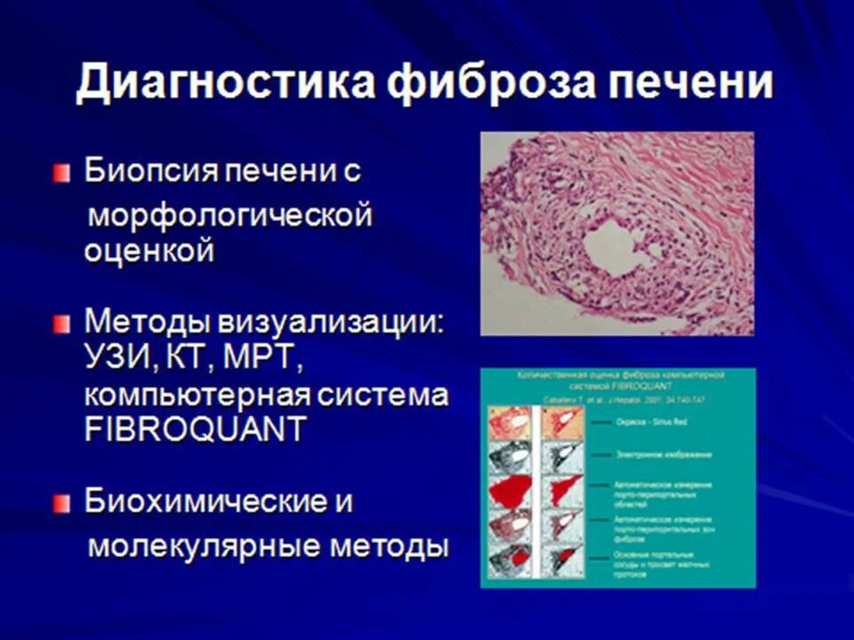 Диагностика фиброза печени. Методы оценки фиброза печени. Симптомы фиброза у мужчин