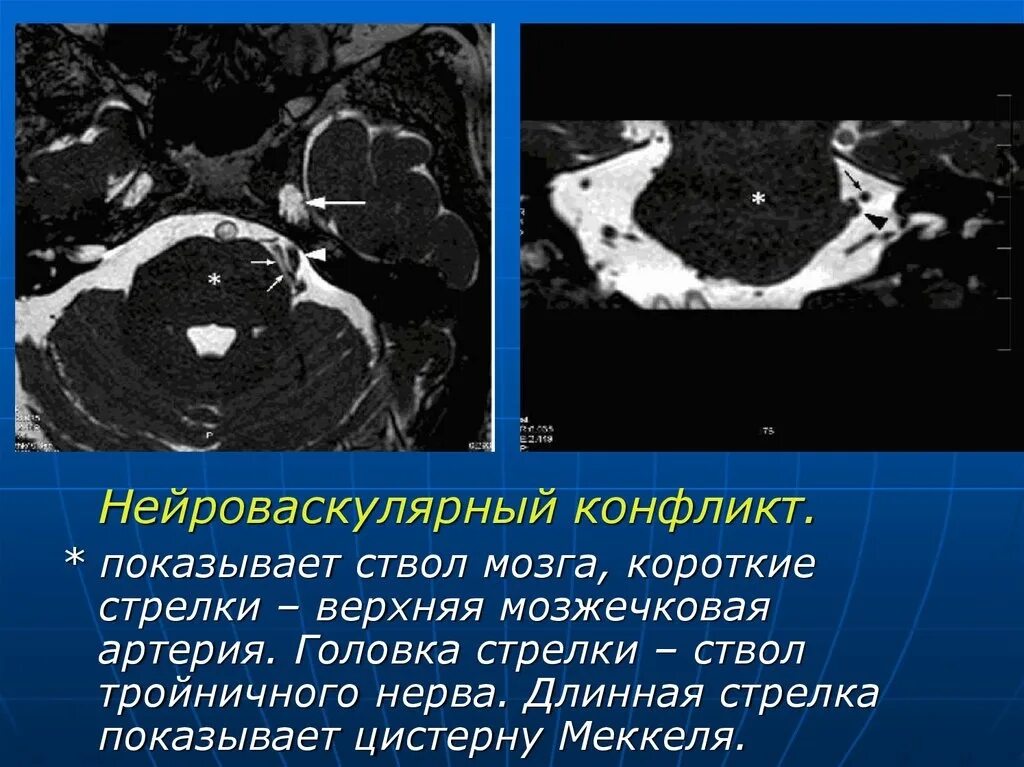 Нейроваскулярный конфликт. Нейроваскулярный конфликт тройничного нерва мрт. Мрт нейроваскулярного конфликта. Neirovaskularni Konflikt troinichnogo Nerva. Мрт лицевого нерва