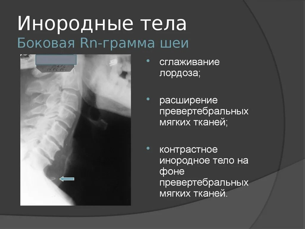 Тело пищевода. Инородное тело мягких тканей. Инородное тело пищевода рентген. Инородные тела на рентгенограмме.