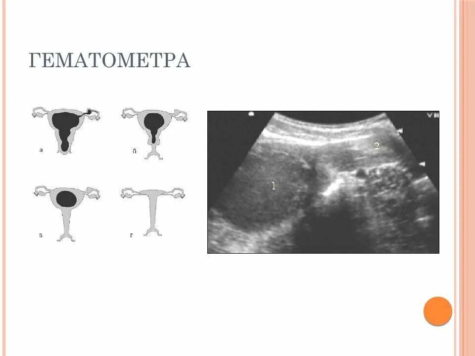УЗИ признаки гематометры. Гематометра гематосальпинкс. Субинволюция гематометра.