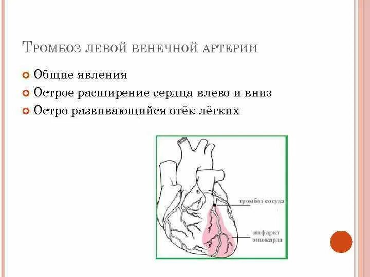 Тромбоз левой венечной артерии. Острое расширение сердца. Тромб венечной артерии сердца. Расширение сердца влево и вниз. Сердечный тромбоз