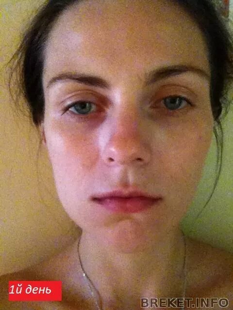 Отек после удаления зуба мудрости. Удаление 8 отзывы. Ретинированного зуба и дистопированного зуба. Удаление восьмерок под общим наркозом. Удаление 8 отзывы.