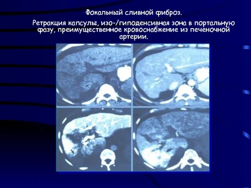 Ретракция капсулы печени на кт. Ретракция капсулы печени на кт на кт. Ретракция капсулы печени что это. Гиподенсивное образование в печени