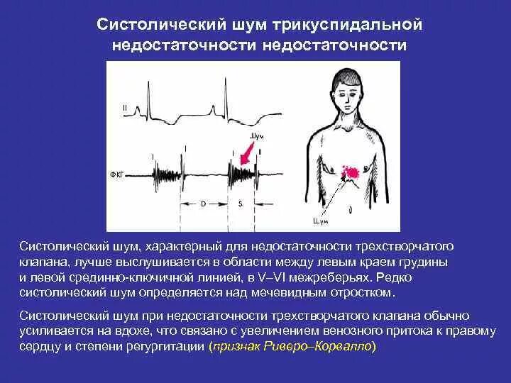 Шум на вдохе. Систолический шум в сердце у ребенка. Шумы сердца при недостаточности трикуспидального клапана. Шум в сердце при трикуспидальной недостаточности. Систолический шум у левого края грудины.