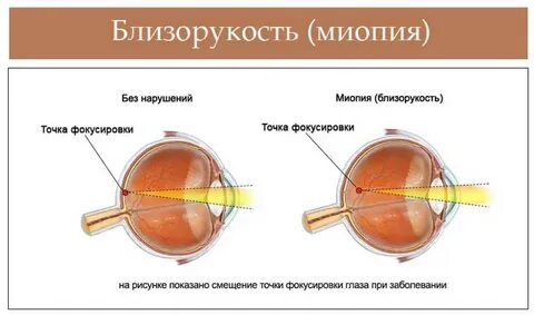 Для миопии характерно