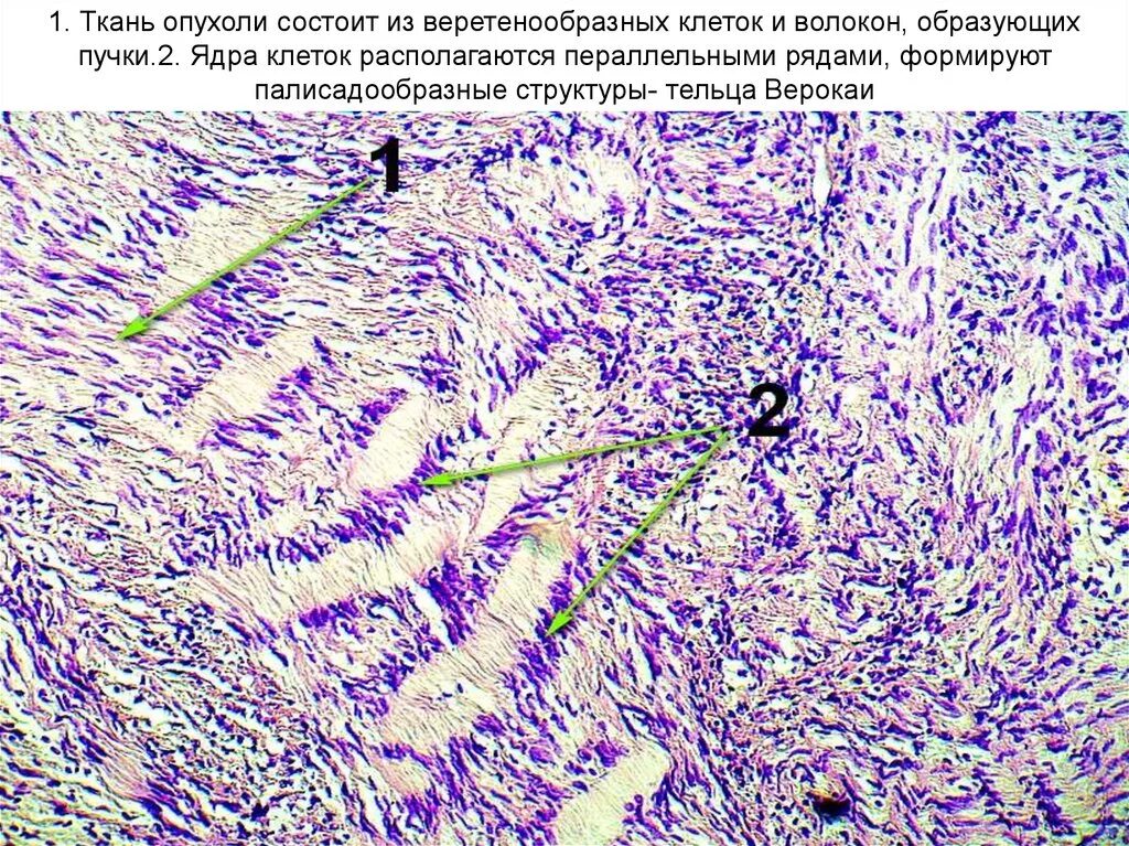 Состоят из многоядерных веретеновидных клеток. Неврилеммома невринома гистология. Невринома шваннома препарат. Тельца Верокаи гистология.