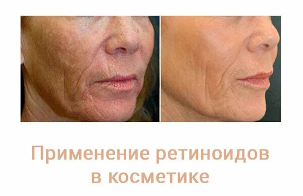 Использование ретиноидов. Применение ретиноидов.
