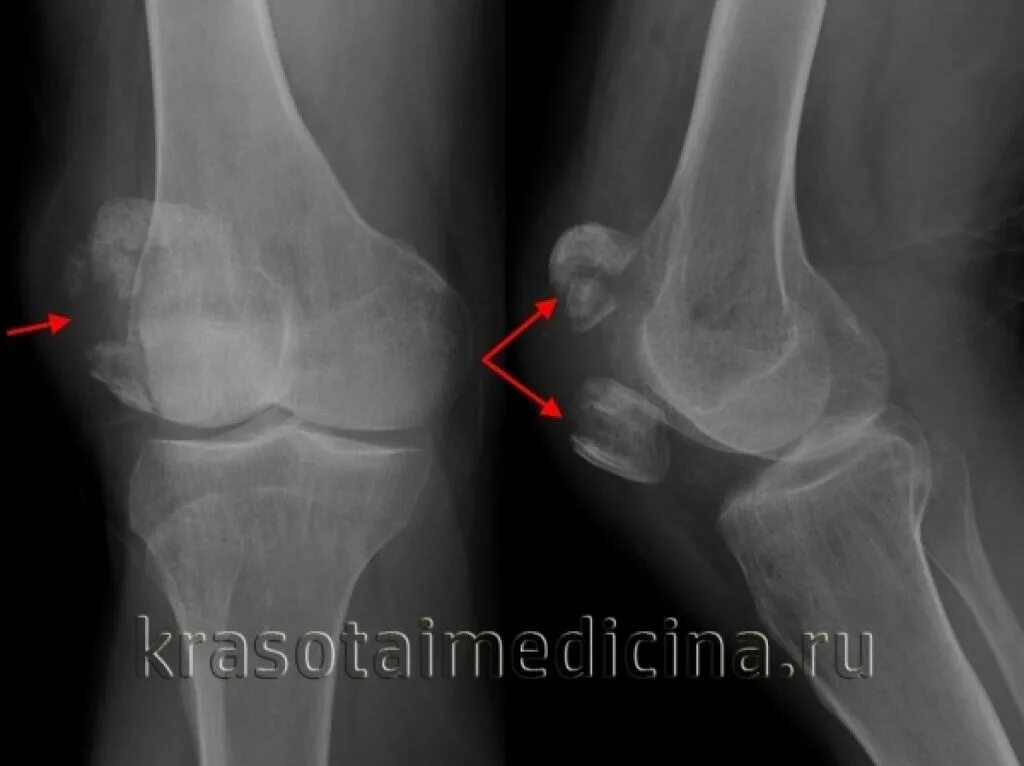 Гемартроз коленного сустава рентген. Перелом надколенника рентген. Гемартроз на рентгене колена. Перелом надколенника мкб 10. Перелом надколенника операции
