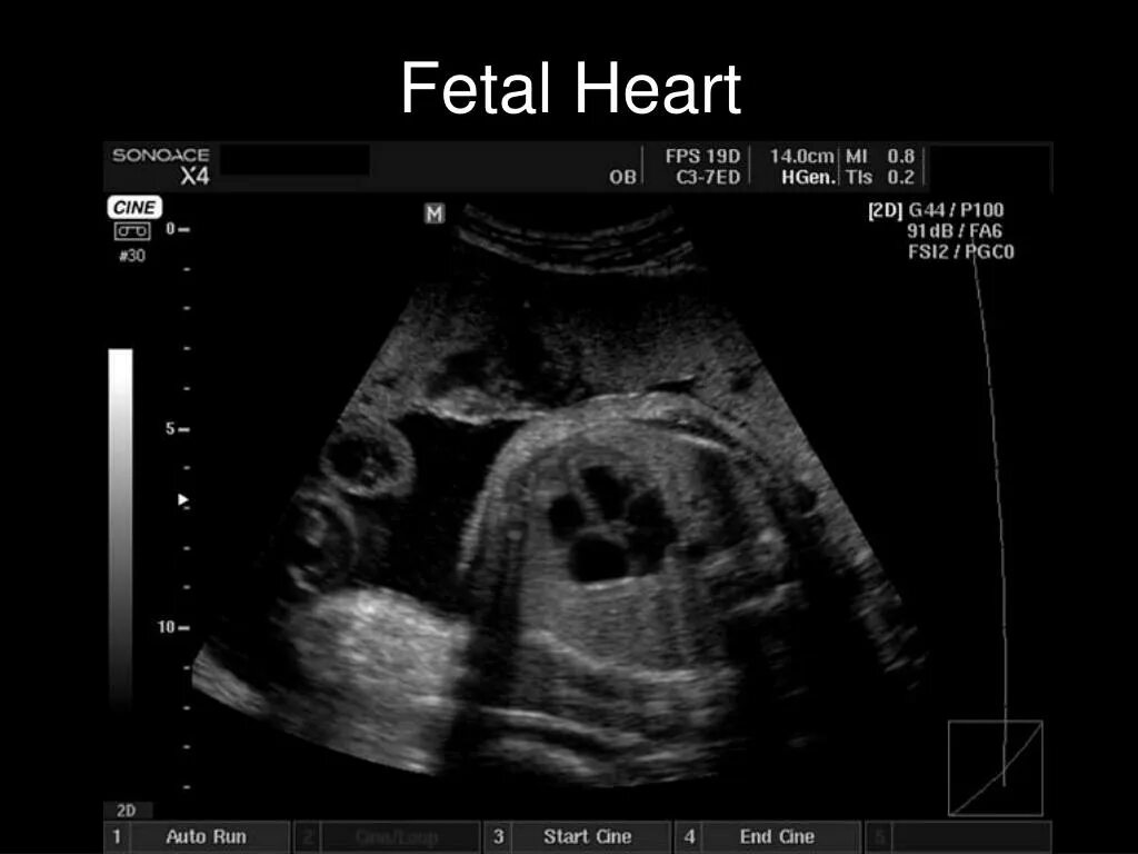 15 неделя сердцебиение. УЗИ сердца плода 20 недель. ЭХОКГ УЗИ У беременных.
