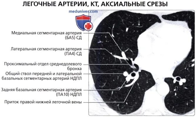 В легочной артерии содержится. Анатомия легочных артерий кт. легочные артерии на кт. ветви легочной артерии на кт. сегментарные артерии легких кт.