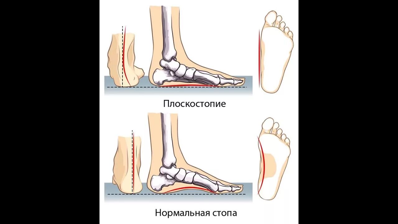 Можно ли избавиться от плоскостопия