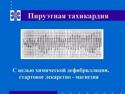 Пируэтная тахикардия