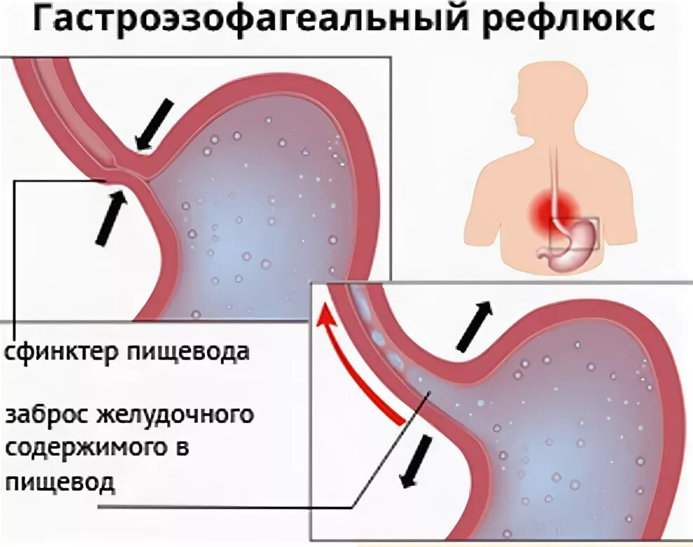 Как убрать рефлюкс. Гастроэзофагеальная рефлюкс-болезнь. Гастроэзофагеальный рефлюкс Гастроэзофагеальная болезнь. Гастроэзофагеальная рефлюксная болезнь с эзофагитом. Гастроэзофагеальный (желудочно-пищеводный) рефлюкс.