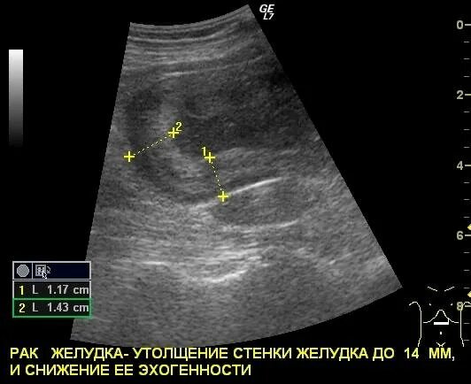 Трансабдоминальное узи желудка. Прободная язва желудка узи. Перфоративная язва узи. Ультразвуковая локация желудка. Язвенная болезнь желудка узи.