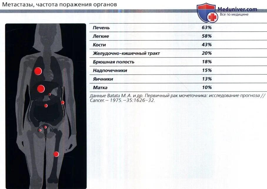 Органы мишени метастазов. Метастазирование опухоли почки. Отдаленные метастазы почки. Метастазы опухоли почки.
