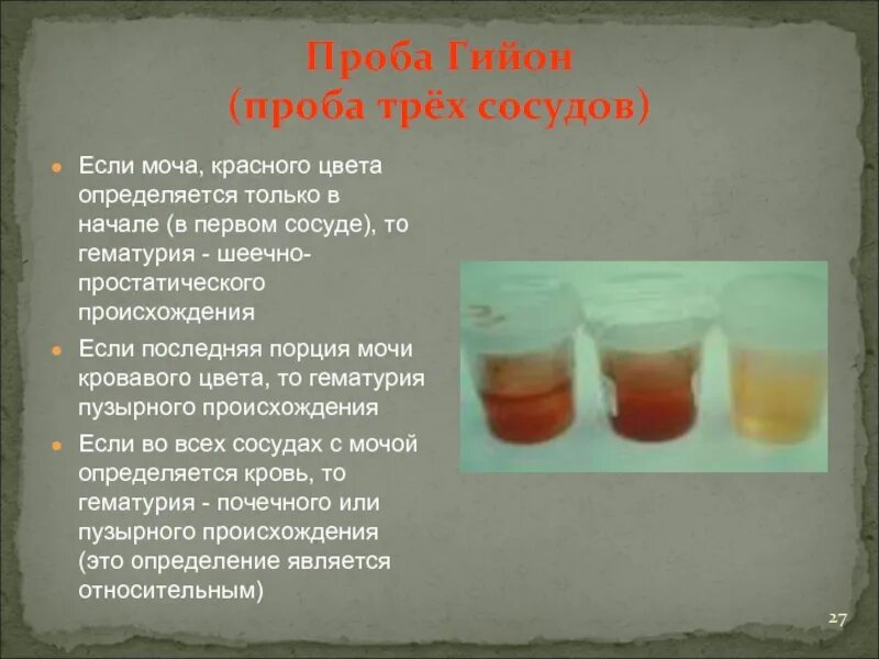 Моча в 3 литровую банку