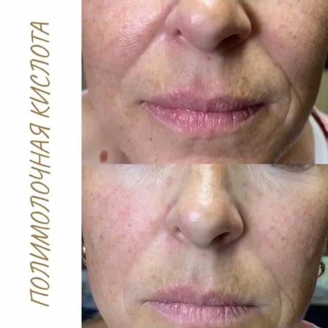 сыворотка лифтинг meso-fill isov sorex. Sculptra aestefill. белое солнце косметология саратов. армирование лица полимолочной кислотой. препараты полимолочной кислоты в косметологии.