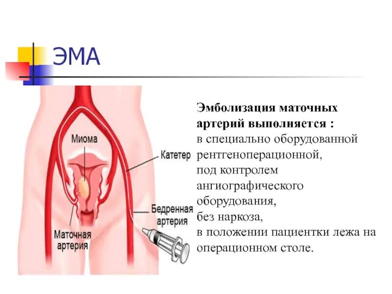 Эма миомы матки