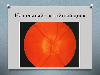 Отек зрительного