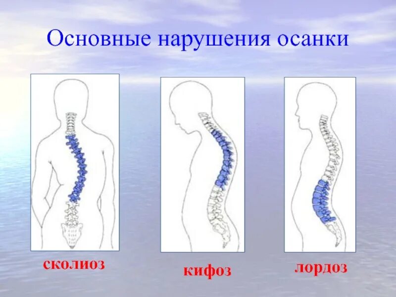 Нарушение изгиба позвоночника. Кифоз лордоз и сколиоз позвоночника. Нарушение осанки кифоз сколиоз. Искривление позвоночника кифоз и лордоз. Лордоз кифоз сколиоз сутулость.