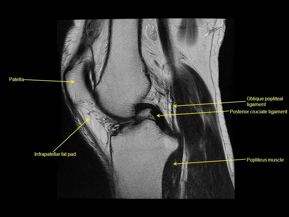 связки надколенника мрт