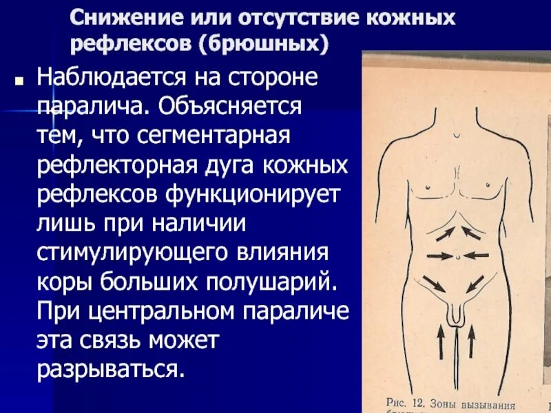 Снижение кожных (брюшных) рефлексов. Кожные брюшные рефлексы. Отсутствие брюшных рефлексов. Исследование брюшных рефлексов.