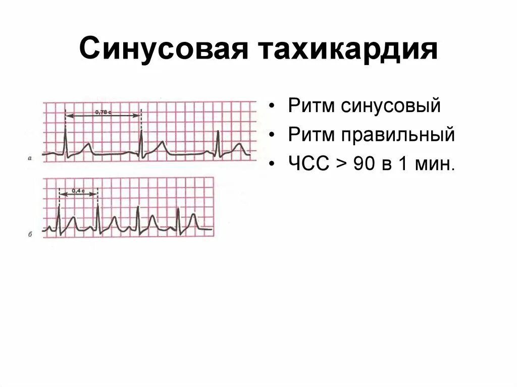 Синусовая тахикардия вертикальное. Синусовая тахикардия на ЭКГ. ЭКГ синусовая тахикардия пленка. ЭКГ при синусовой тахикардии рисунок. ЭКГ проявления синусовой тахикардии.