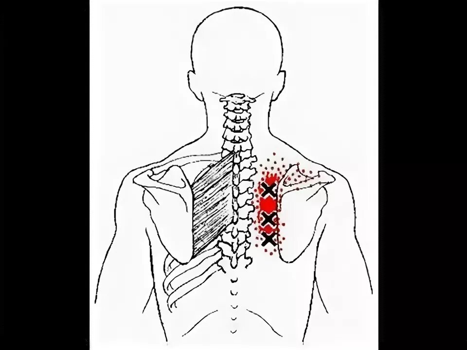 Боли возле лопатки справа. Триггерные точки трапециевидной мышцы. Трапециевидная мышца спины триггерные точки. Триггерные точки ромбовидной мышцы. Ромбовидная мышца спины триггерные точки.