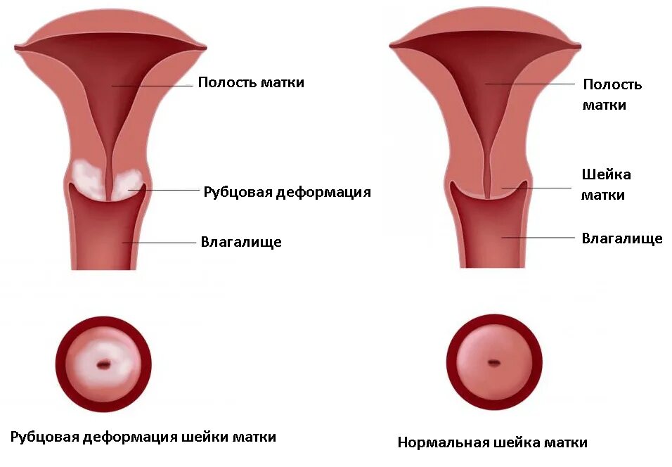 Рк шейки матки симптомы. Расширение полости матки с жидкостным содержимым. Рубцовая деформация матки. Конизация диатермокоагуляция шейки матки. Что значит деформированная матка.