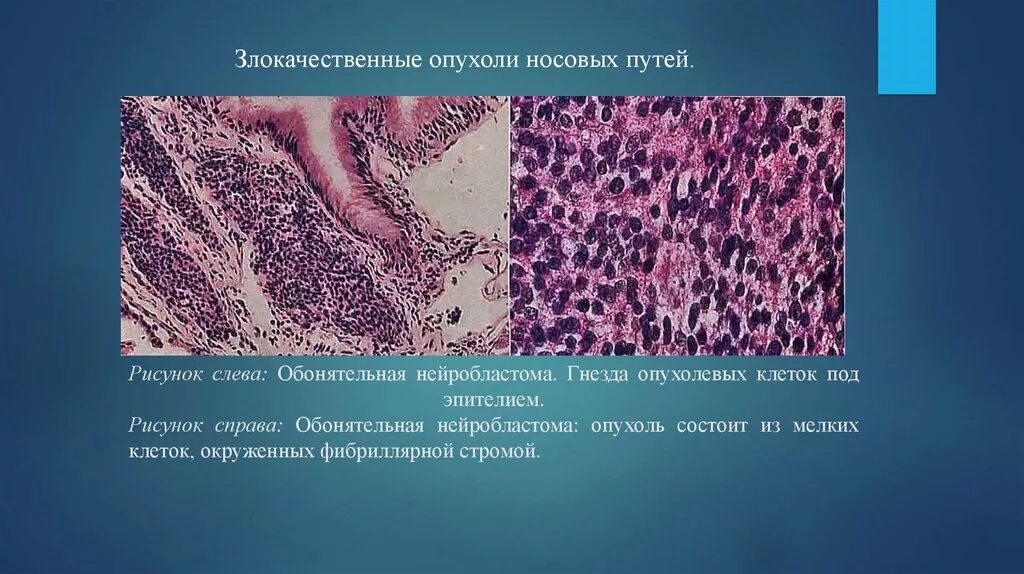 Эстезионейробластома гистология. Злокачественная опухоль. Доброкачественные и злокачественные опухоли для презентации. Злокачественные опухоли виды. Злокачественная опухоль из соединительной