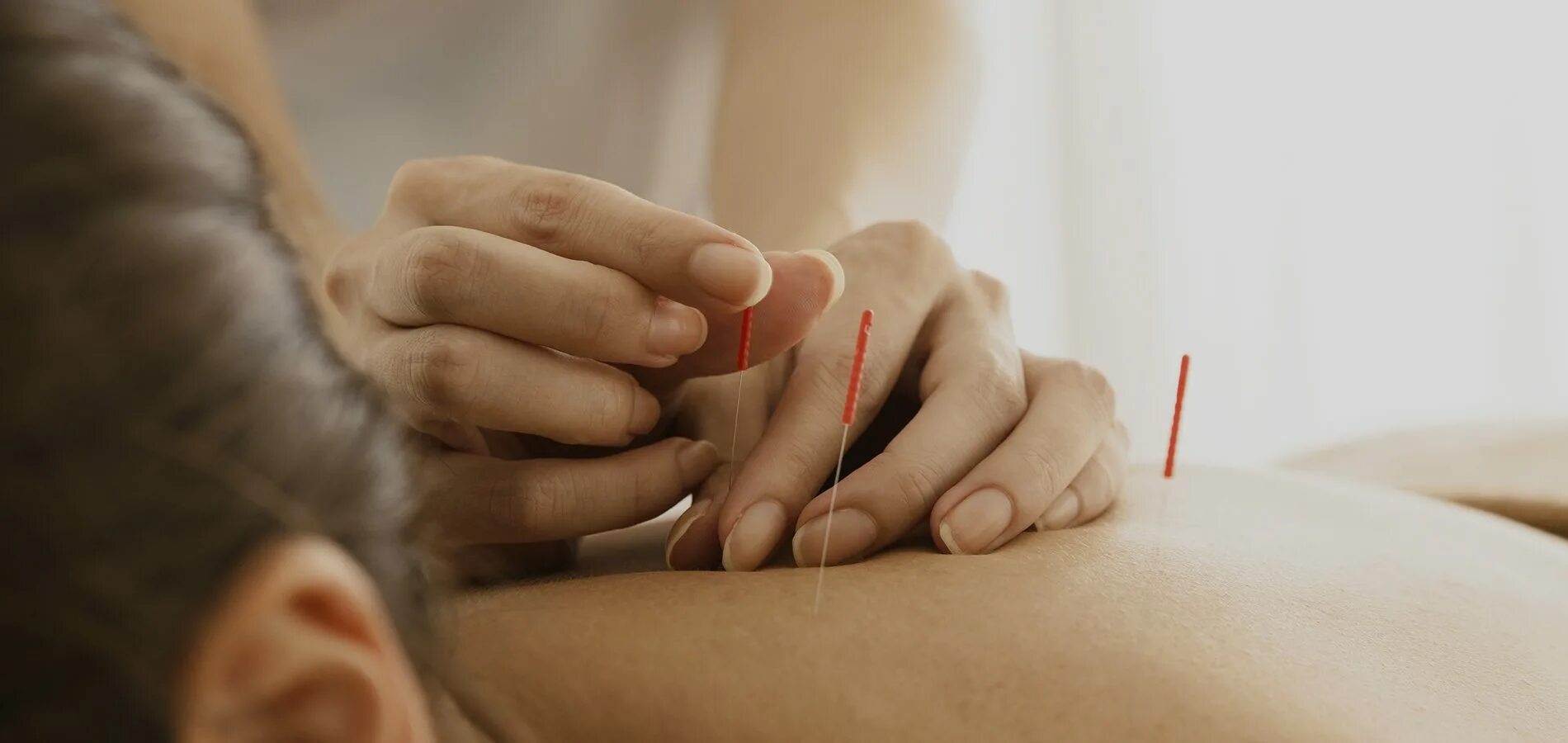 Акупунктура от алкоголизма. Кодировка иглоукалыванием от алкоголизма. Кодировка иглоукалыванием. Иглотерапия от алкоголизма. Иголки для мануальной терапии.