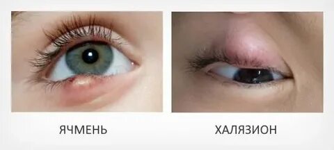 Халязиум