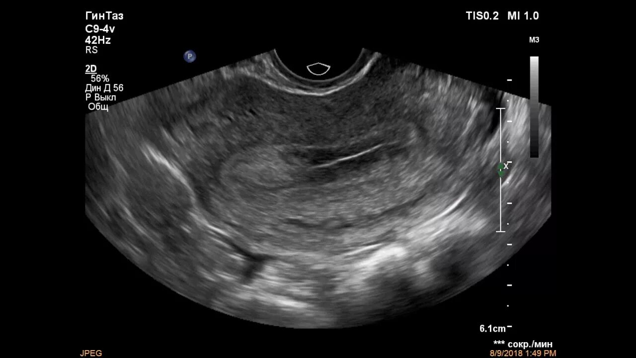 Полип эндометрия в матке на УЗИ. Эхограммы полип эндометрия. Полип в эндометрии матки отзывы