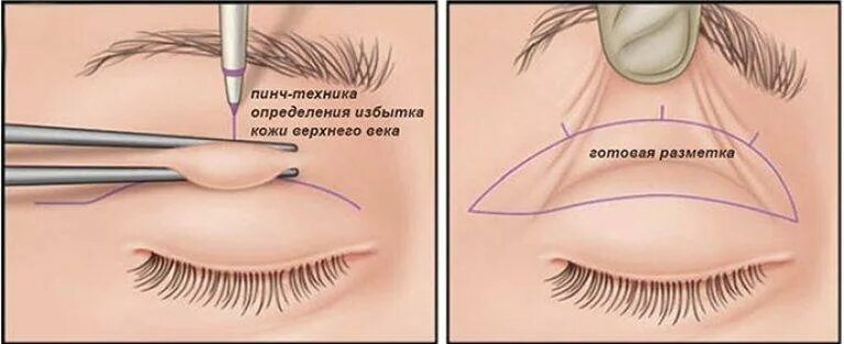 Пластика верхних век метод пинч. Пластика нижних век пинч метод. Нижняя блефаропластика пинч техника. Blefaroplastika верхнего века. Поднять веки без операции