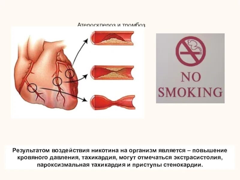Воздействие никотина на сосуды. Влияние курения на кровеносную систему человека. Влияние никотина на кровеносную систему. Влияние курения на сосуды. Сужение сосудов последствие