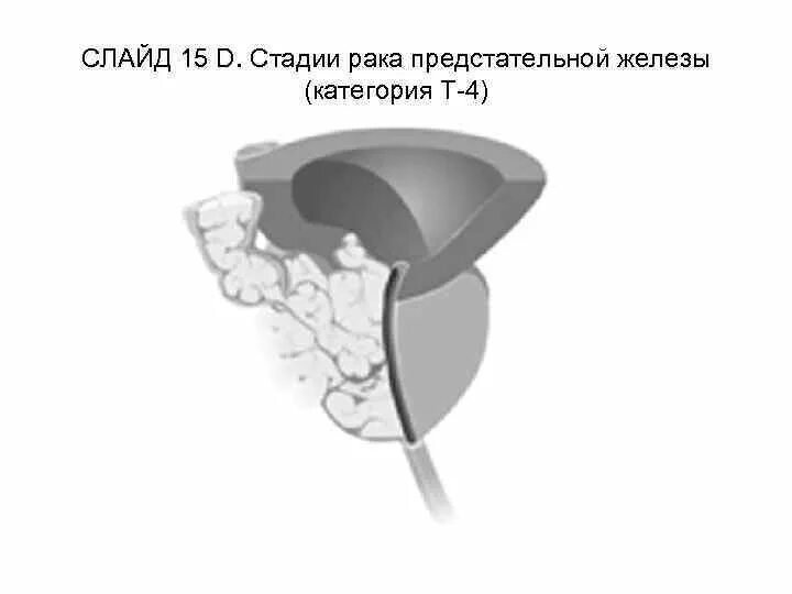 Предстательная железа рак лечится. Стадии онкологии предстательной железы. Опухоль предстательной железы степени. Карцинома 4 степени предстательной железы. Онкология простаты 4 степени.