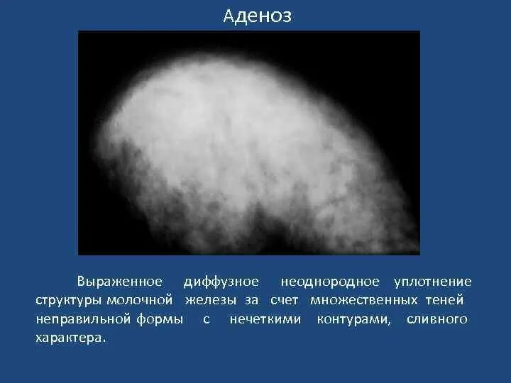 Признаки аденоза молочных желез. Признаки аденоза молочных желез