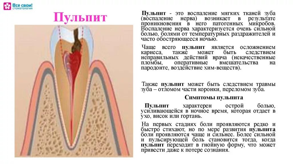 Причины почему болит зуб. Симптомы пульпит и периодонтит. Пульпит - воспаление пульпы зуба.