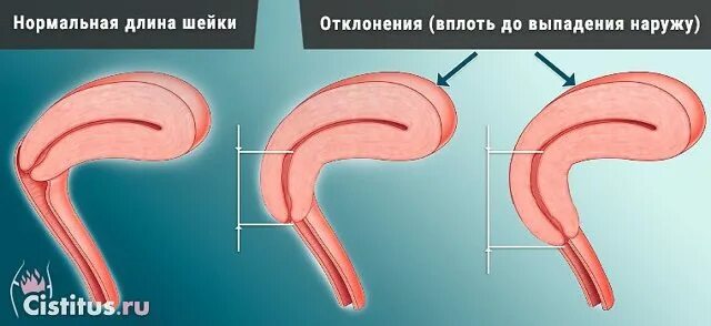 Как удлинить матку. Элонгация шейки матки степени.