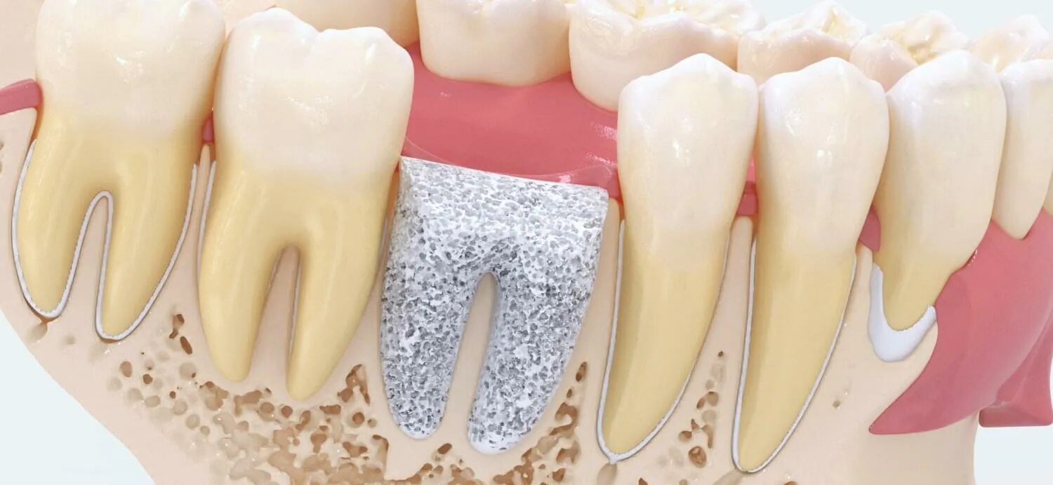 Восстановление костной ткани зубов