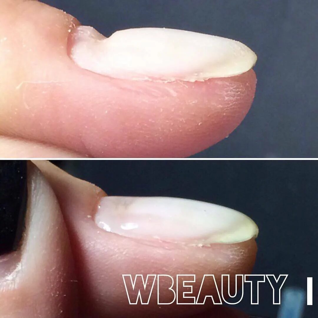 Маникюр до и после. Глубокий пропил. Аппаратный маникюр пропилы на ногтях. Глубокий пропил. Пропилы после аппаратного маникюра.